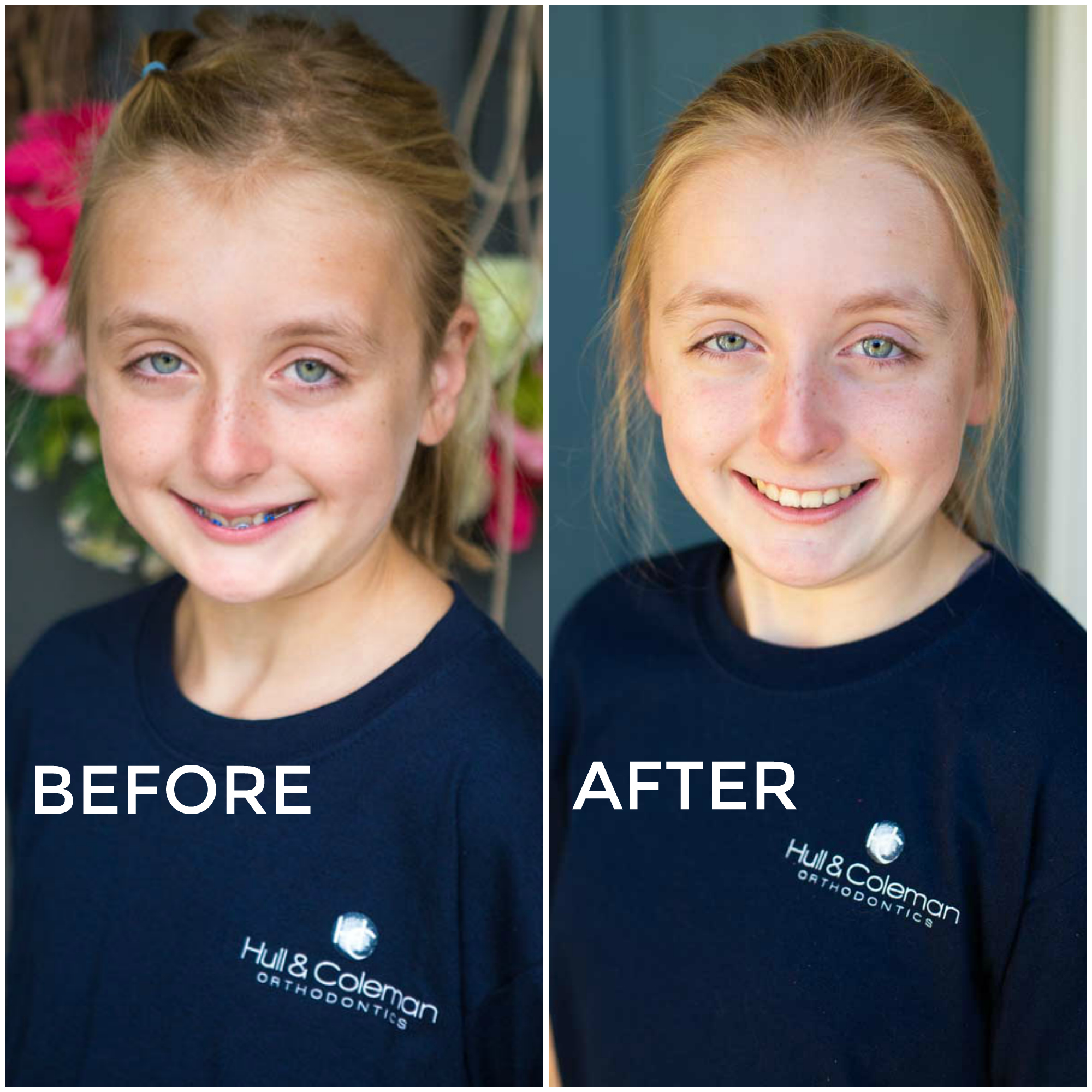 Before and After Braces picture. In just 2 years it is amazing what the team at Hull & Coleman can do to adjust a tween's smile.